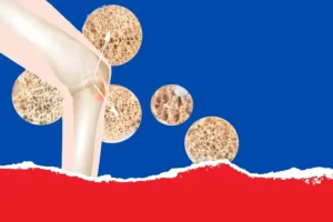 هشاشة العظام